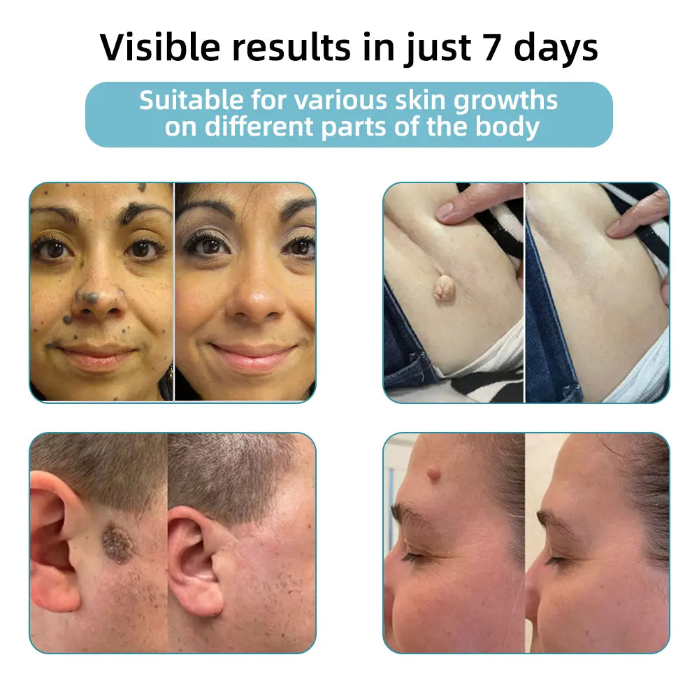 Kidsneed® Non-Invasive Laser Pen | Mole, Wart & Skin Tag Removal Device